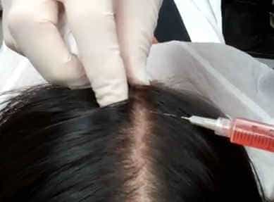 мезотерапия волос